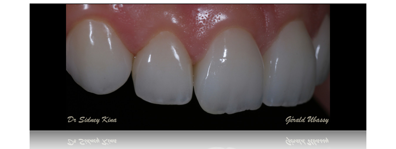 12 Veneers, Kina /Ubassy